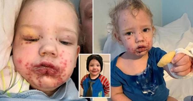 متى يتحول الهربس إلى خطر صحي حقيقي؟ طبيب يحذر من المضاعفات الخطيرة