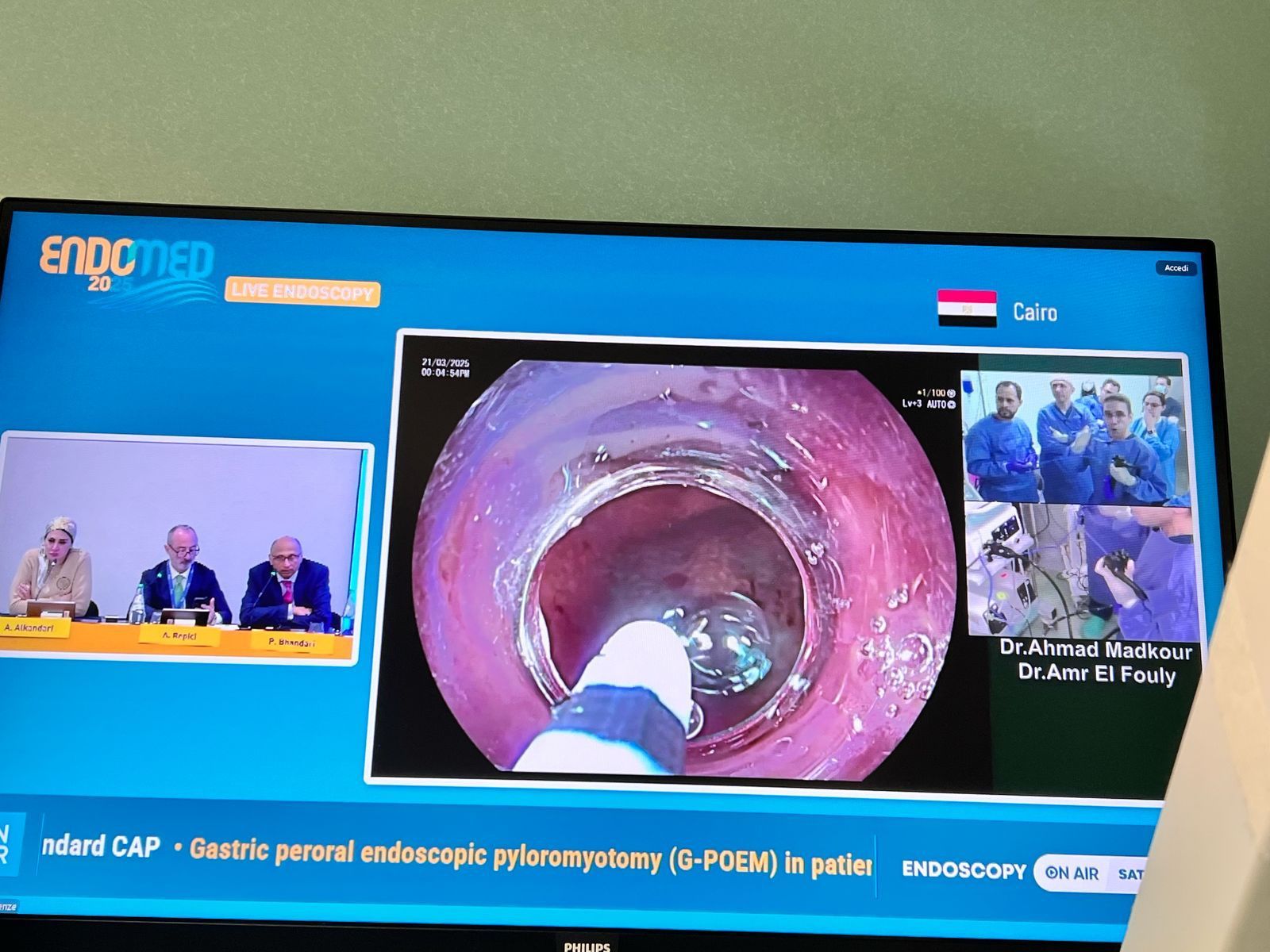 إنجاز طبى لجامعة حلوان: جراحة نادرة بمناظير الفراغ الثالث وبث مباشر لـ9 دول