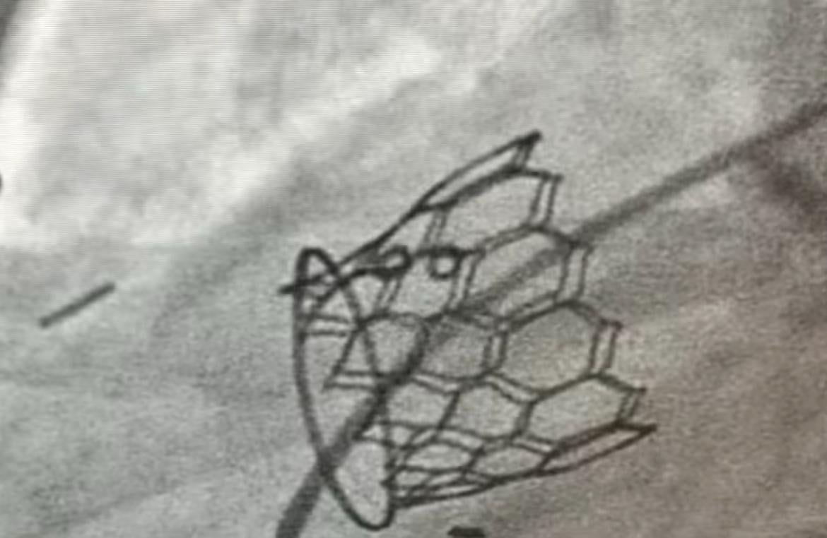 معهد القلب ينجح فى إجراء 4 عمليات زراعة صمام رئوي باستخدام تقنية "MYVAL"