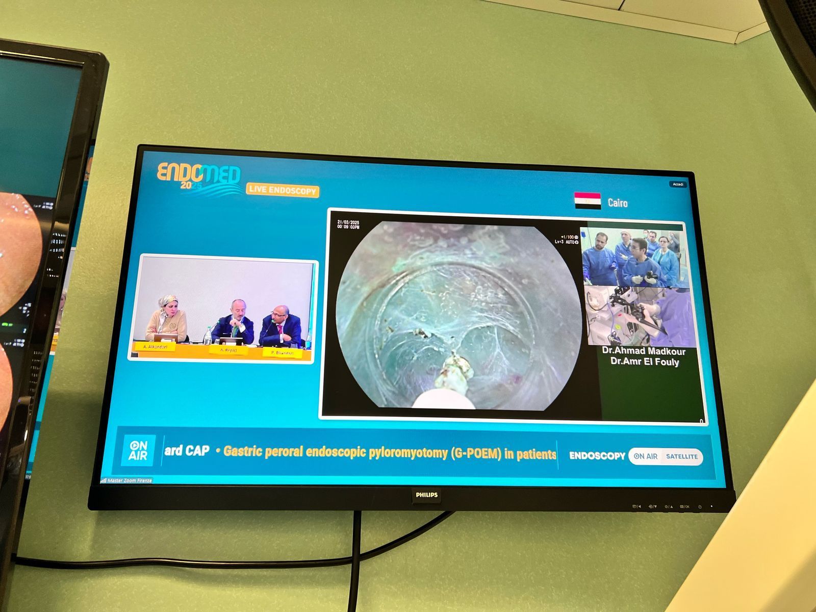 إنجاز طبى لجامعة حلوان: جراحة نادرة بمناظير الفراغ الثالث وبث مباشر لـ9 دول