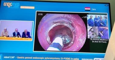 إنجاز طبى لجامعة حلوان: جراحة نادرة بمناظير الفراغ الثالث وبث مباشر لـ9 دول