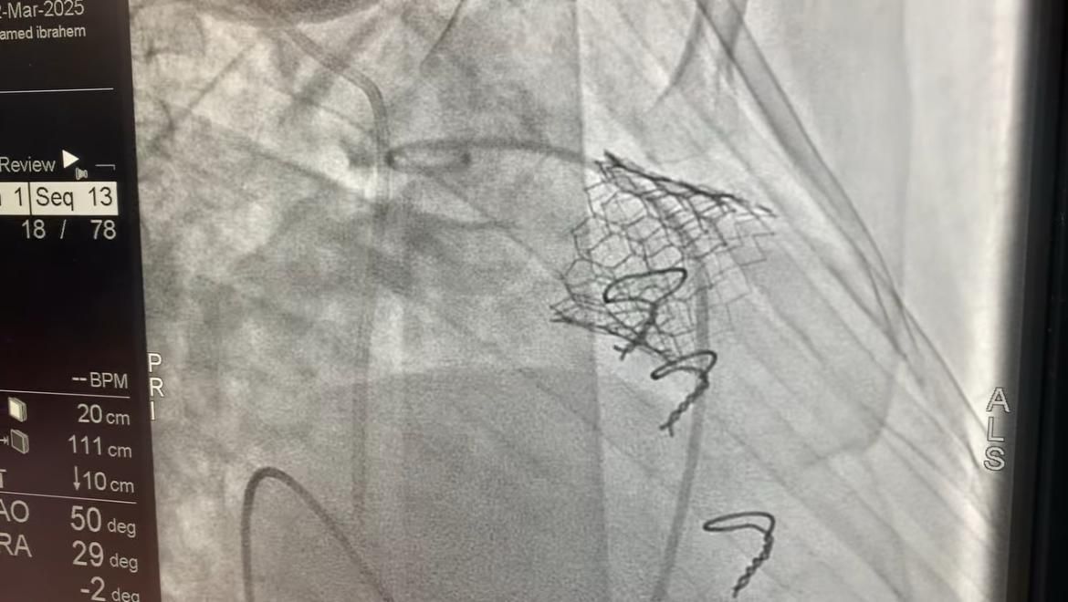 معهد القلب ينجح فى إجراء 4 عمليات زراعة صمام رئوي باستخدام تقنية "MYVAL"