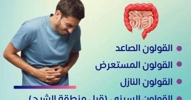 وزارة الصحة تكشف معلومات مهمة عن سرطان القولون (إنفوجراف)