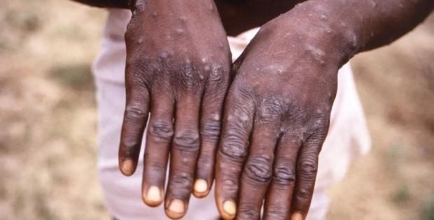 سلالات قاتلة وسريعة الانتشار.. تحذيرات جديدة من جدري القرود