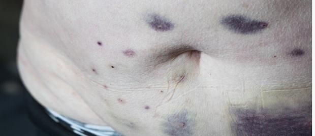 أمراض خطيرة تسبب ظهور علامات زرقاء على الجسم.. راقبها فورا