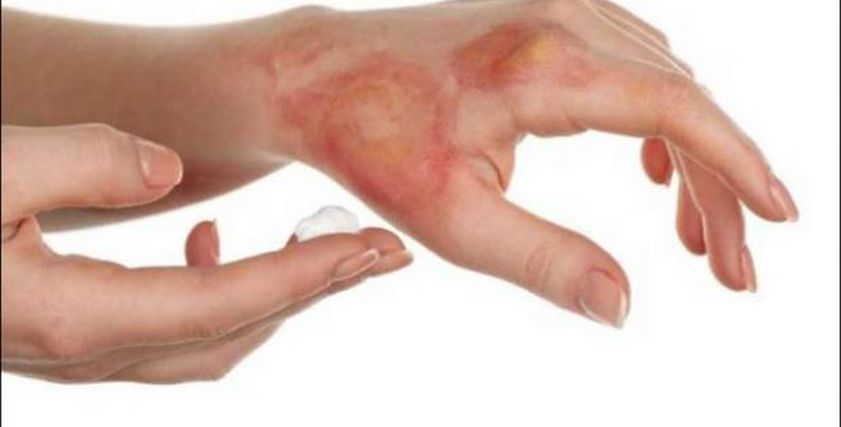 ماذا تفعل إذا تعرضت لحروق من الدرجة الأولى؟.. إليك الحل الأمثل