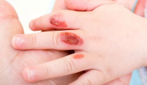 ماذا تفعل إذا تعرضت لحروق من الدرجة الأولى؟.. إليك الحل الأمثل