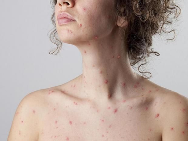 تفشي «مبوكس» يهدد العالم بوباء جديد.. تعرف على الأعراض وطرق الوقاية