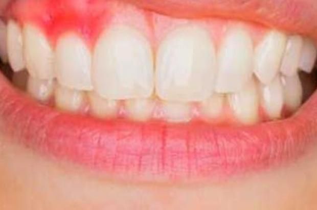 أعراض التهاب اللثة وطرق الوقاية من النزيف.. اعرفها
