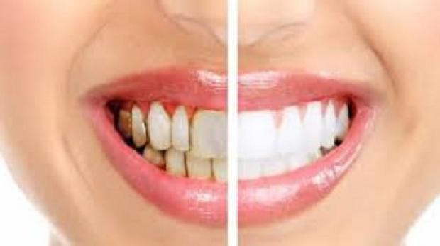 أعراض التهاب اللثة وطرق الوقاية من النزيف.. اعرفها