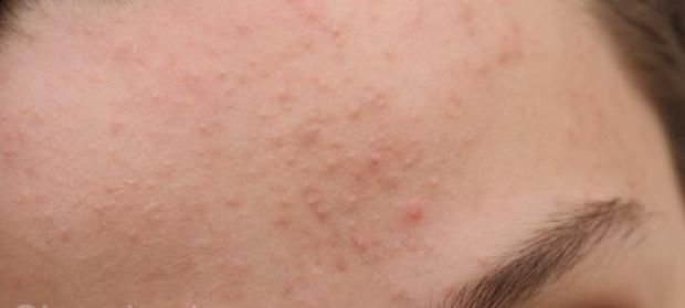 5 طرق طبيعية لتجفيف حبوب الوجه دون آثار.. «رطبي بشرتك»