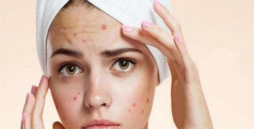 5 طرق طبيعية لتجفيف حبوب الوجه دون آثار.. «رطبي بشرتك»