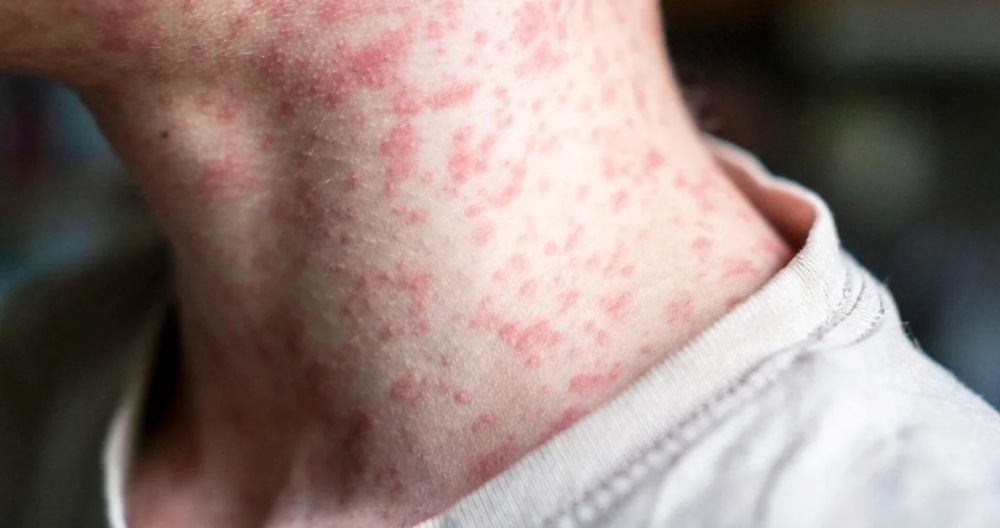 3 وفيات.. وزير الصحة الأمريكى بصدد زيارة تكساس مع تفشي الحصبة