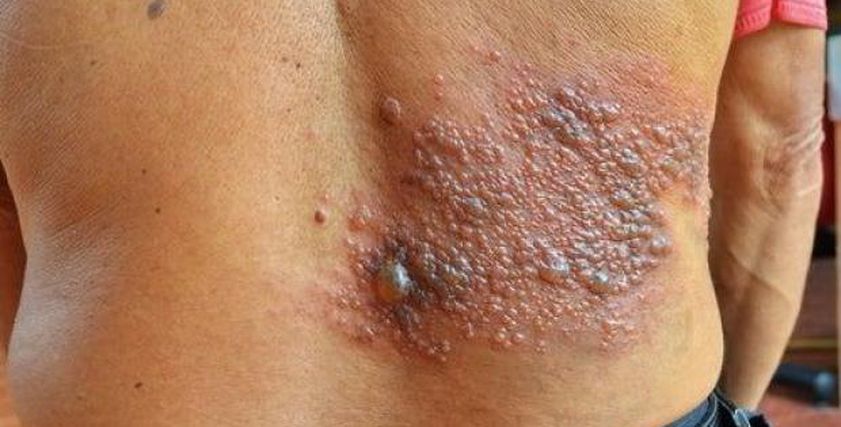 دراسة تكشف علاقة لقاح الحزام الناري بالتقليل من الإصابة بالخرف