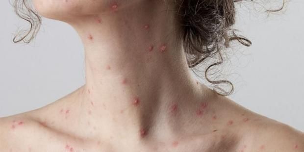 عاجل| خوف عالمي من انتشار سلالة جديدة من جدرى القرود Ib.. اكتشاف أول حالة في بريطانيا