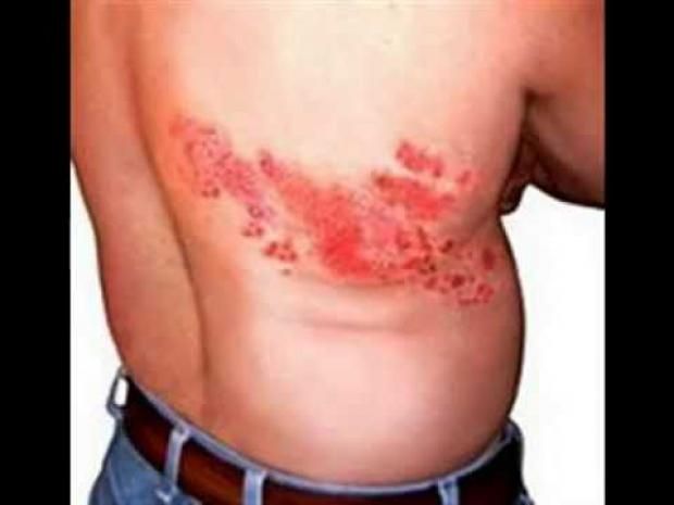 دراسة تكشف علاقة لقاح الحزام الناري بالتقليل من الإصابة بالخرف