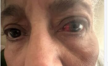 والدة منة فضالي تتعرض لإصابة في عينها وهذا ما حصل!