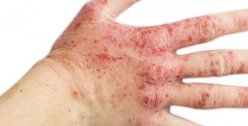 هل يوجد علاج نهائي للإكزيما؟.. 4 طرق للسيطرة عليها وتخفيف آثارها