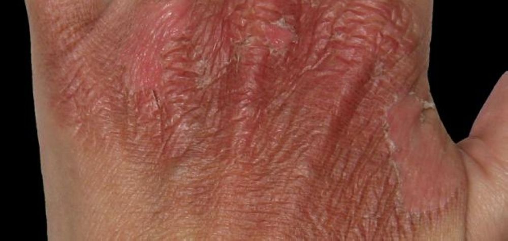 إنقاذ مقيمين من حروق شديدة بالقنفذة وتحويلهما لاستكمال العلاج بمكة