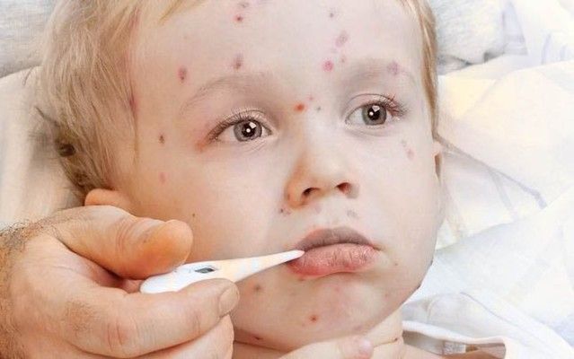 زيادة حالات الحصبة في تكساس إلى 541 والمرض ينتشر في 25 ولاية أميركية