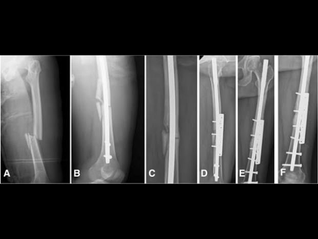 سيناريوهات التعافي بعد جراحة مسمار نخاعي.. دكتور علاج طبيعي يكشف خطة تأهيل القندوسي