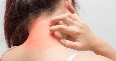 من غير دكتور.. مستشفى بلندن تطور الذكاء الاصطناعي لاكتشاف سرطان الجلد