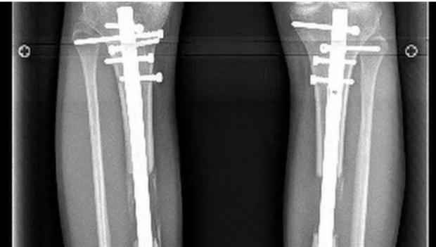تفاصيل عملية أحمد القندوسي بعد الإصابة الخطيرة.. متى يعود للملاعب؟
