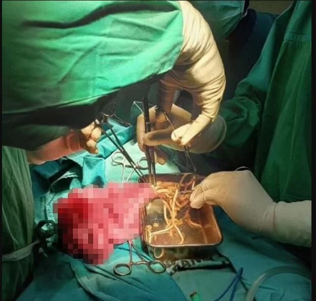 بعد نجاة طفل إندونيسي من الموت بسببها.. أعراض الإصابة بدودة الإسكارس