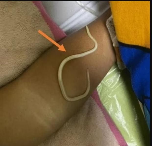 بعد نجاة طفل إندونيسي من الموت بسببها.. أعراض الإصابة بدودة الإسكارس