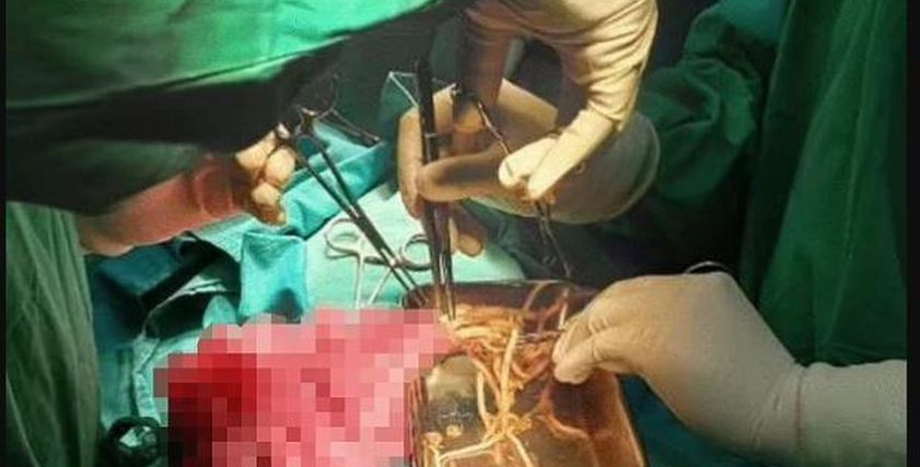 بعد نجاة طفل إندونيسي من الموت بسببها.. أعراض الإصابة بدودة الإسكارس