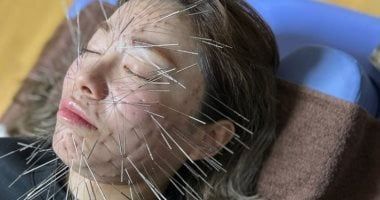 كل ما تريد معرفته عن العلاج بـ الوخز بالإبر