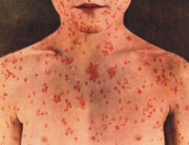 عاجل | فيروس مميت يظهر في تل أبيب.. أعراض يصاب بها المريض قبل الوفاة