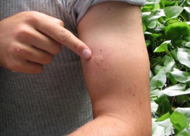 في اليوم العالمي للملاريا.. ما أعراض المرض وكيفية الوقاية منه؟