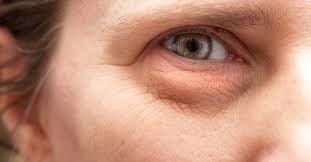 الامارات | للرجال والنساء: تجنبوا هذه الأكلات لأنها سبب الانتفاخ تحت العينين