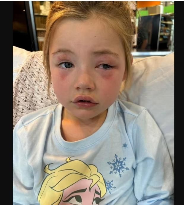 أضرار الإصابة بمواد التنظيف.. مسحوق غسيل شهير يصيب طفلة بالعمى