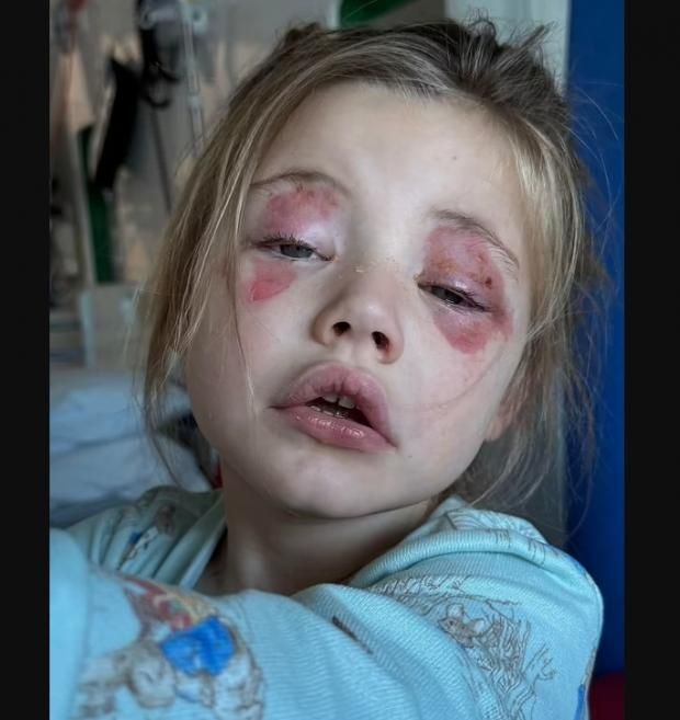 مسحوق غسيل شهير يصيب طفلة بالعمى.. أضرار الإصابة بمواد التنظيف