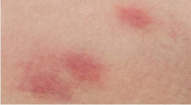 احمِ بشرتك من حساسية الجلد.. خطوات بسيطة تحميك من عدو الصيف الصامت