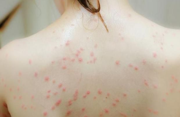 احمِ بشرتك من حساسية الجلد.. خطوات بسيطة تحميك من عدو الصيف الصامت