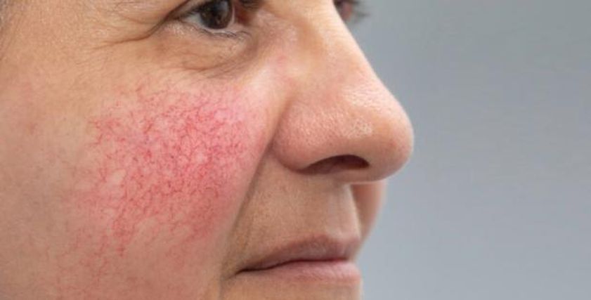 مرض مزعج يصيب الوجه ويؤثر على الملامح.. كيف تتعامل معه؟