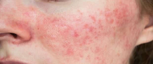 مرض مزعج يصيب الوجه ويؤثر على الملامح.. كيف تتعامل معه؟