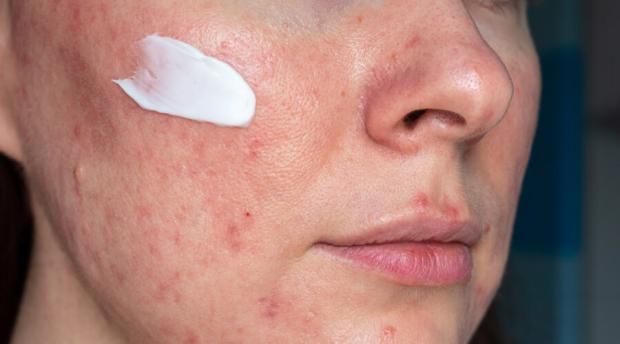 مرض مزعج يصيب الوجه ويؤثر على الملامح.. كيف تتعامل معه؟
