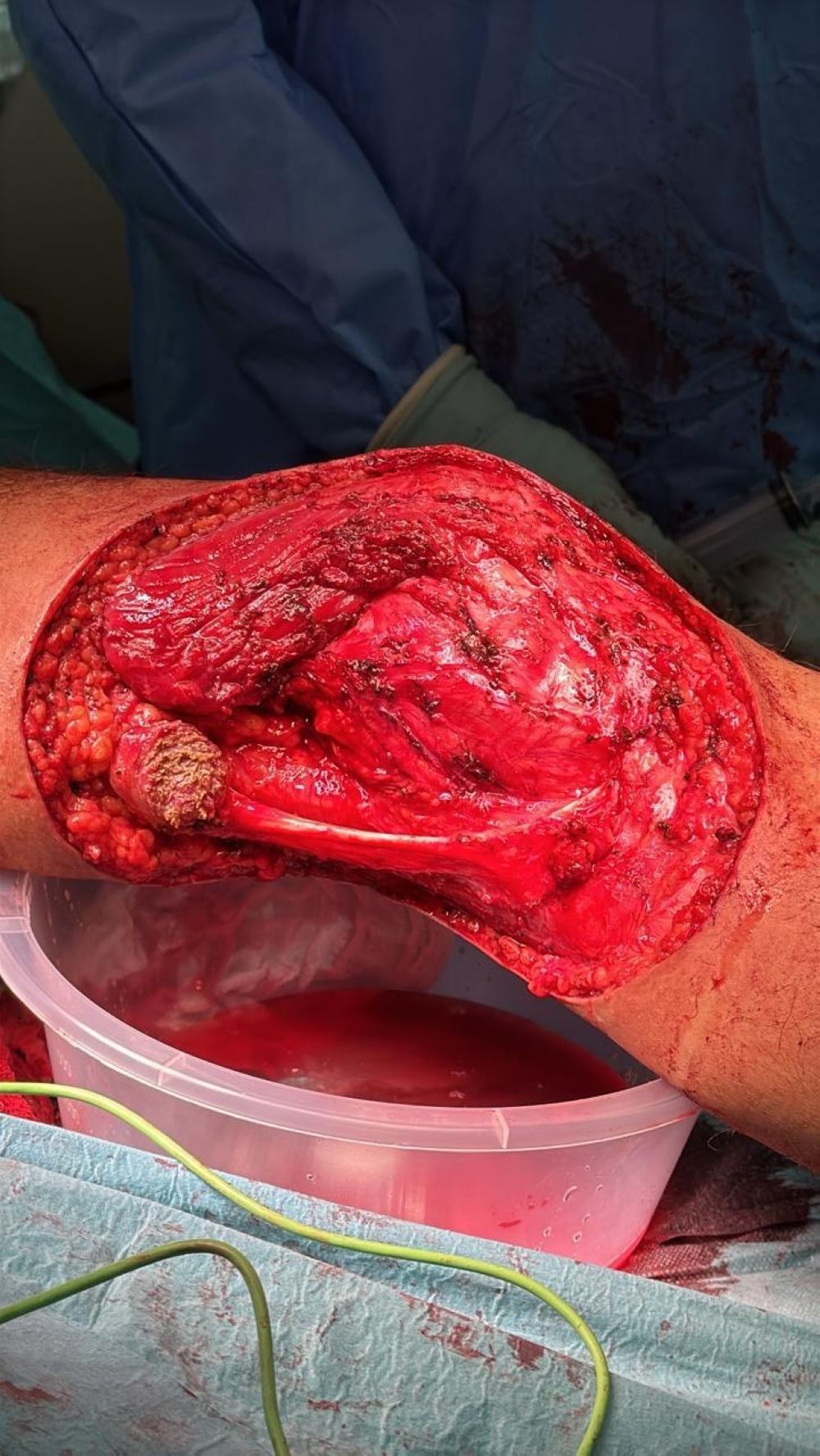 "مكة الصحي".. استئصال ورم متقدم من ركبة سعودي ينهي معاناة أشهر