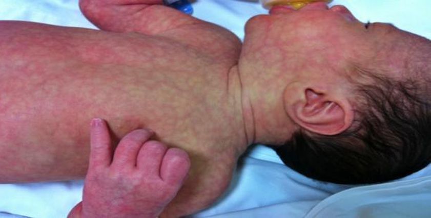 شبكة زرقاء على الجلد منذ الولادة قد تخفي أمراضًا خطيرة.. تعرف عليها