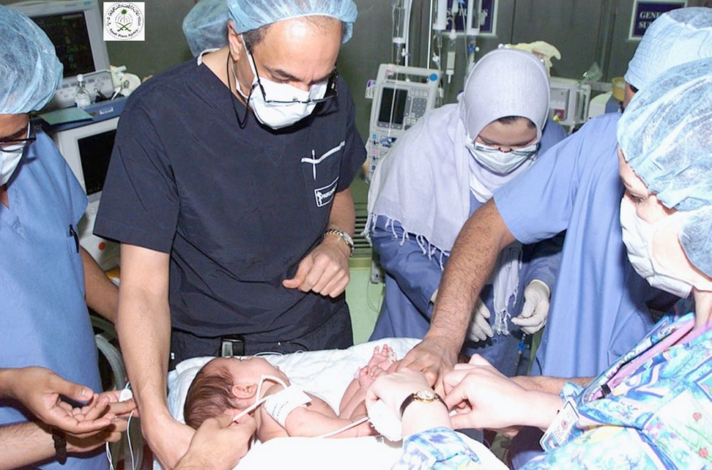 لأعوام من النجاح.. المملكة موطن لعمليات فصل توائم مصريين