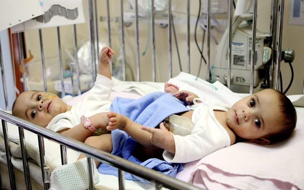 لأعوام من النجاح.. المملكة موطن لعمليات فصل توائم مصريين