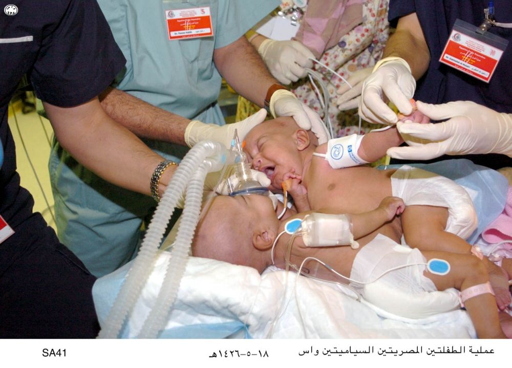 لأعوام من النجاح.. المملكة موطن لعمليات فصل توائم مصريين