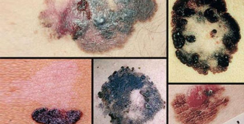 بقعة على الجلد قد تكون سرطانا.. اعرف أعراض الميلانوما وأسبابها وطرق علاجها