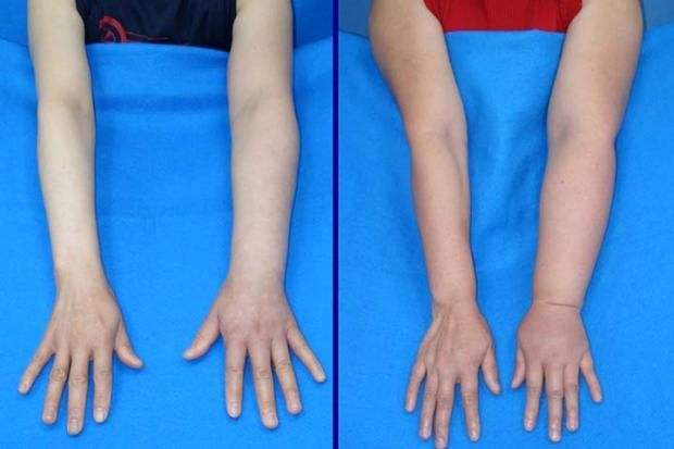 ما الوذمة اللمفاوية؟.. حالة صحية تعاني منها كندة علوش