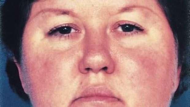 أسباب تغير شكل الوجه.. تعرف على «متلازمة كوشينج» وآثارها الجانبية