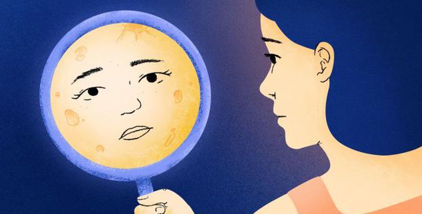 أسباب تغير شكل الوجه.. تعرف على «متلازمة كوشينج» وآثارها الجانبية